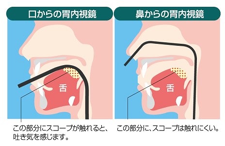 特徴2　経鼻と経口は、お好きな方をお選びいただけます